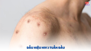 dấu hiệu hiv 2 tuần đầu