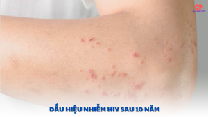 dấu hiệu nhiễm hiv sau 10 năm