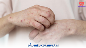 dấu hiệu của hiv là gì