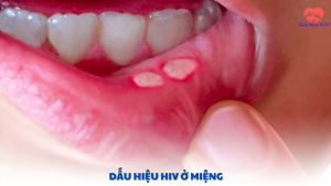 dấu hiệu hiv ở miệng