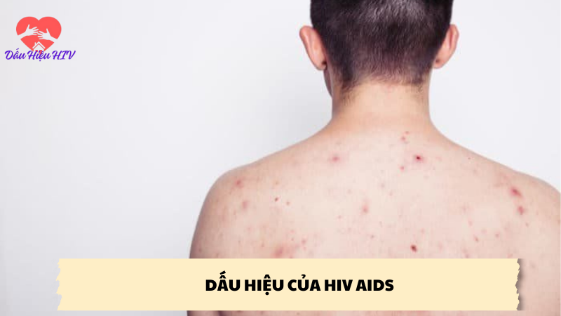 dấu hiệu của hiv aids