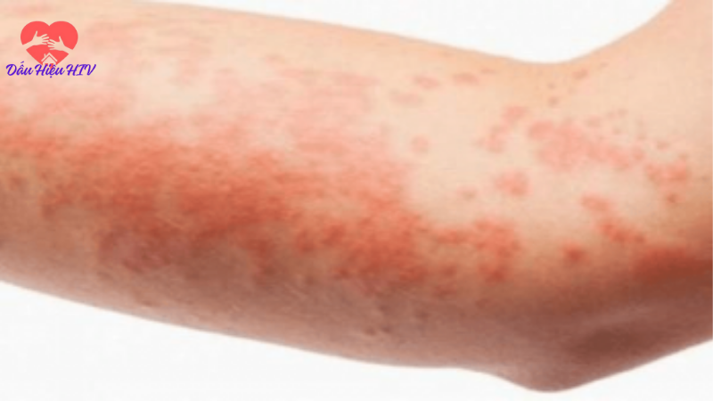 dấu hiệu của hiv aids