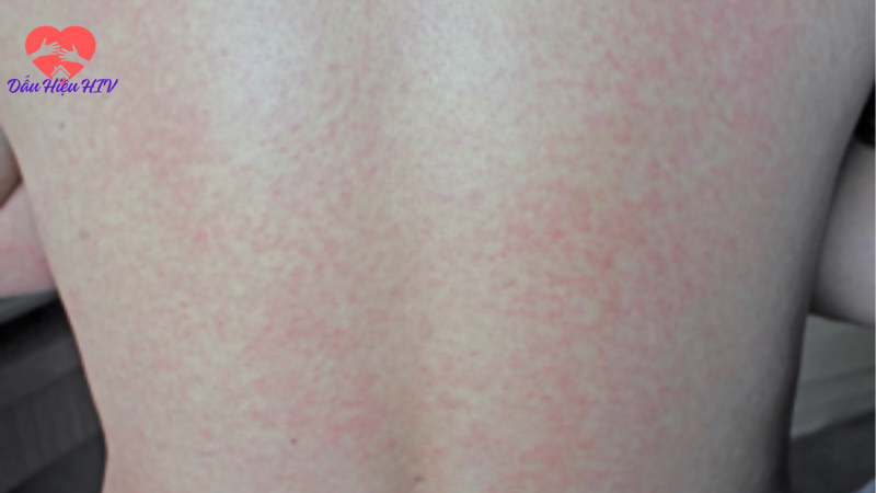 dấu hiệu của hiv aids