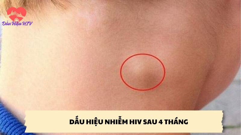 dấu hiệu nhiễm hiv sau 4 tháng