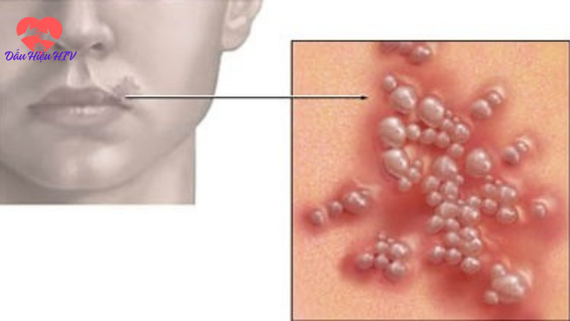 dấu hiệu hiv ở nữ sau 3 tháng